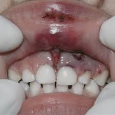 dental injury