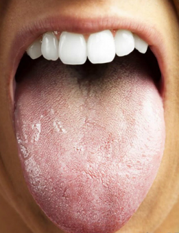 Tongue coating